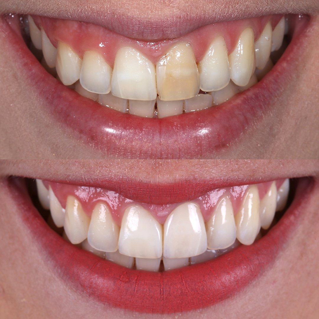Caso 3 - Antes e depois Artis