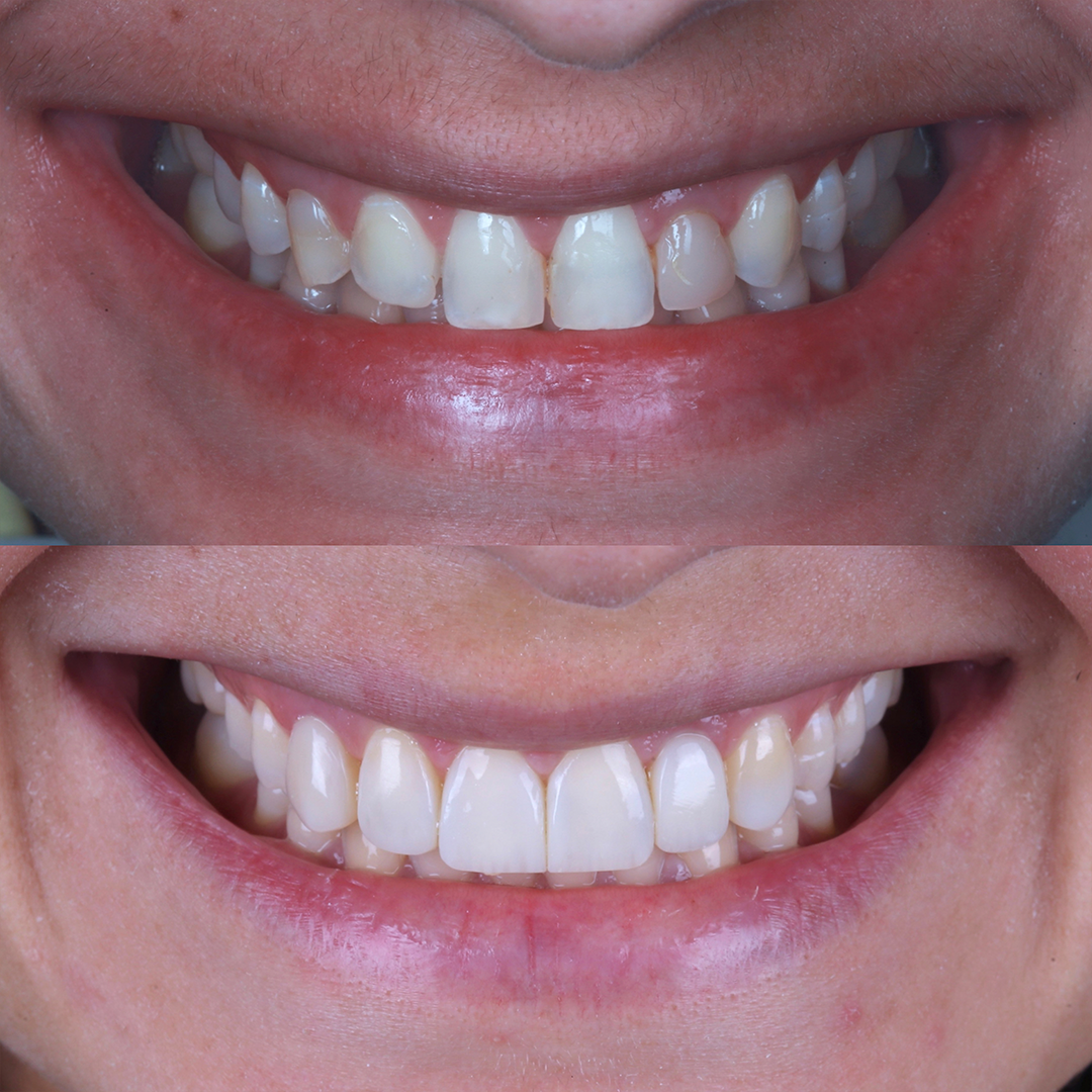 Caso 2 - Antes e depois Artis