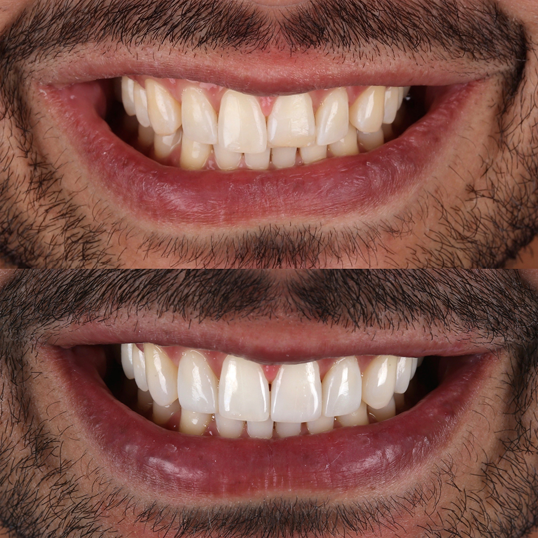 Caso 4 - Antes e depois Artis