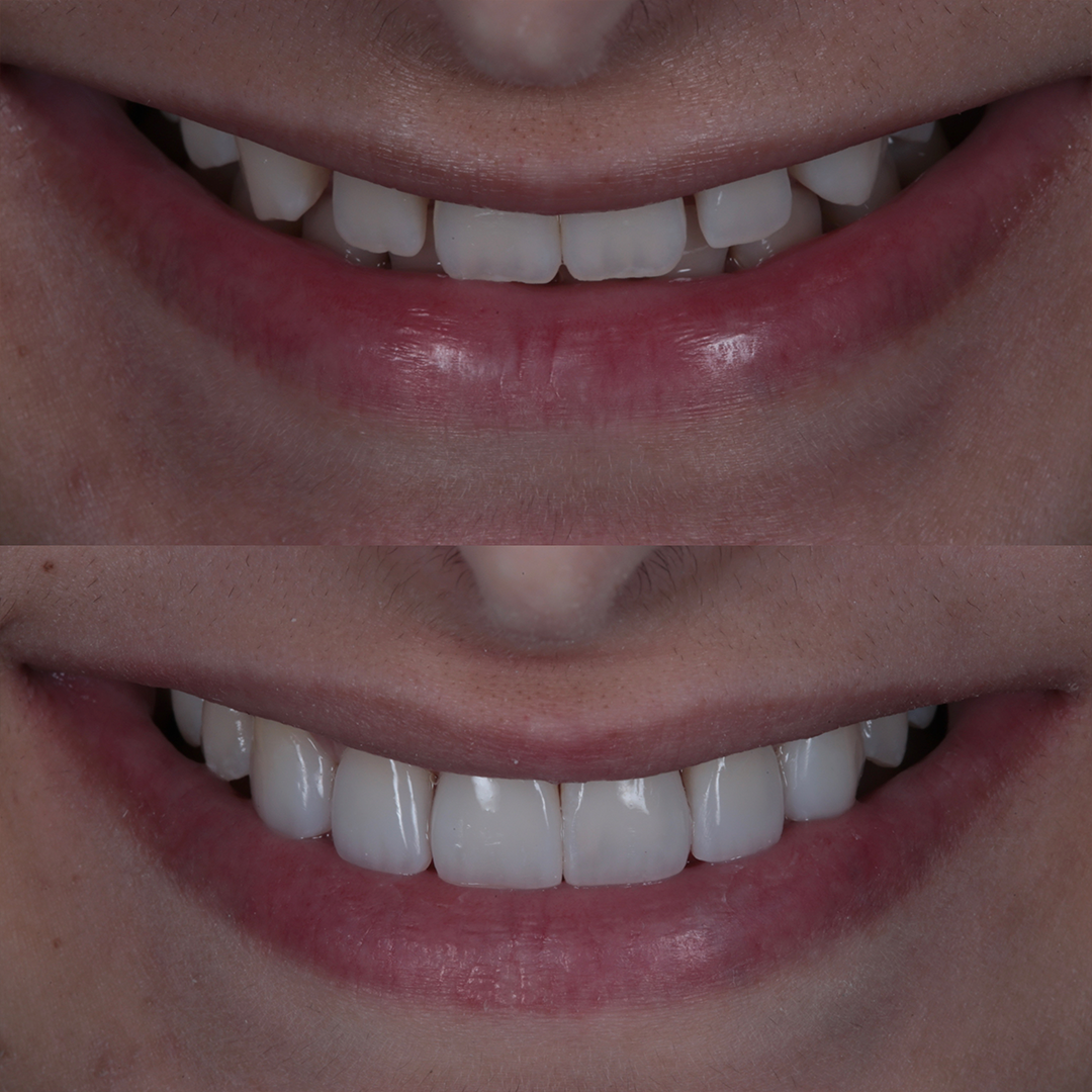 Caso 5 - Antes e depois Artis